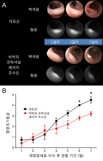Professor Euiheon Chung's research team develops endoscopic treatment of early colorectal cancer using non-ablative fractional laser therapy 이미지